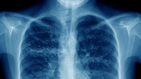 X ray of lungs
